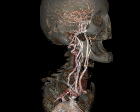CT der Gefäße (CT-Angiographie)