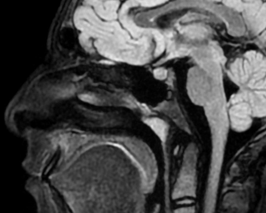 Magnetresonanztomographie (MRT)